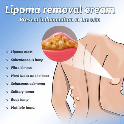 Herbal Lipoma Removal Cream (Pack of 2)